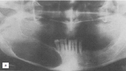 FENESTRATION /DECOMPRESSION/ The contraction of the