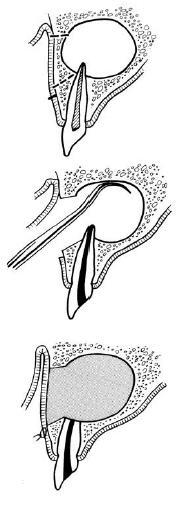 CYSTECTOMY (PARTSCH II) 1. Mucoperiosteal flap 2. Bone window 3.