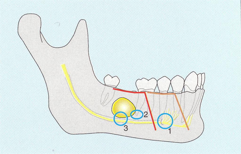 POSSIBLE COMPLICATIONS OF CYSTECTOMY 1.