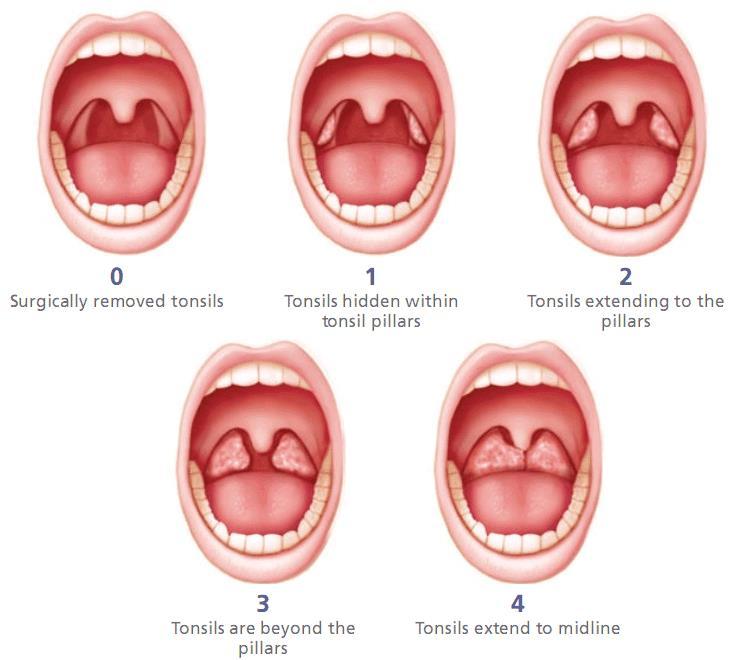 Friedman Tonsilla méret score A tonsilla palatina obstruktív szerepét mutatja az OSAS kialakításában. 3-4 grade-nek jó a műtét utáni prognózisa Otolaryngol Head Neck Surg. 2015 May;152(5):969-73.