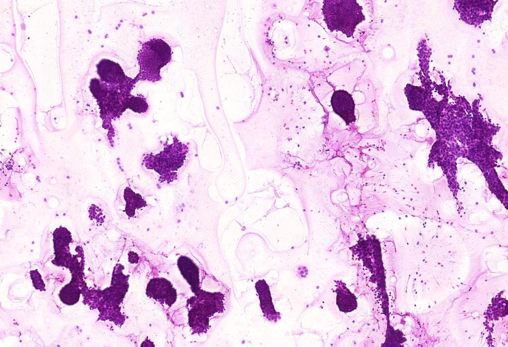 FNA: benignus tumor (emlő