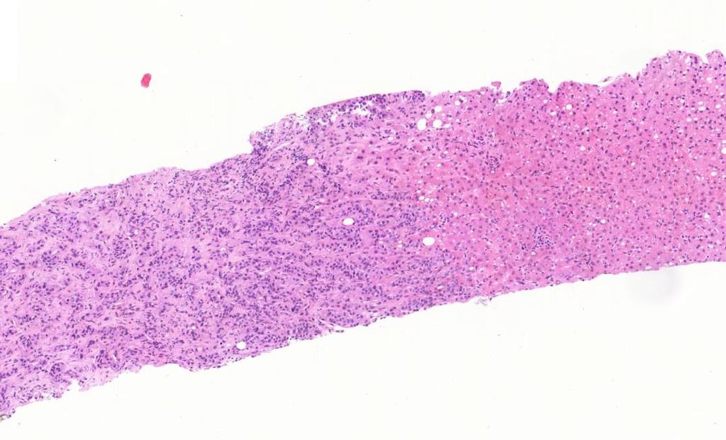 CNB: liver metastasis Normal liver: