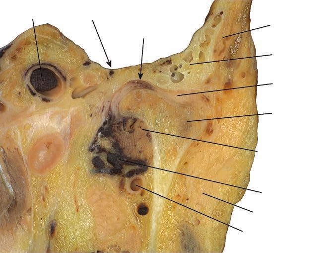 temporalis tuberculum articulare fossa mandibularis area retrodiscalis discus articularis arcus zygomaticus átmetszete fossa infratemporalis m.