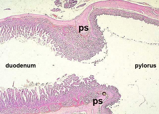 Pylorus duodenum átmenet Megkülönböztető