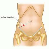 Appendix vermiformis Az appendix lehetséges helyzetei és gyakoriságuk: bázisa a medioinguinalis vonalon fekszik a cecumból az ileum beszájadzása alatt nyílik McBurney pont tuberculum