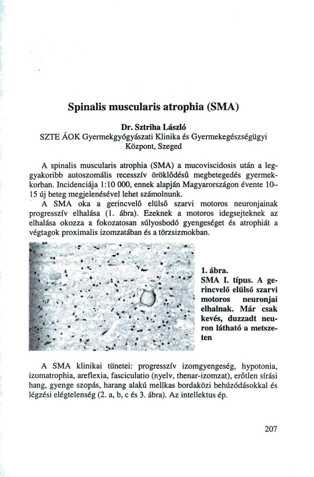 Spinalis muscularis atrophia (SMA) Dr.