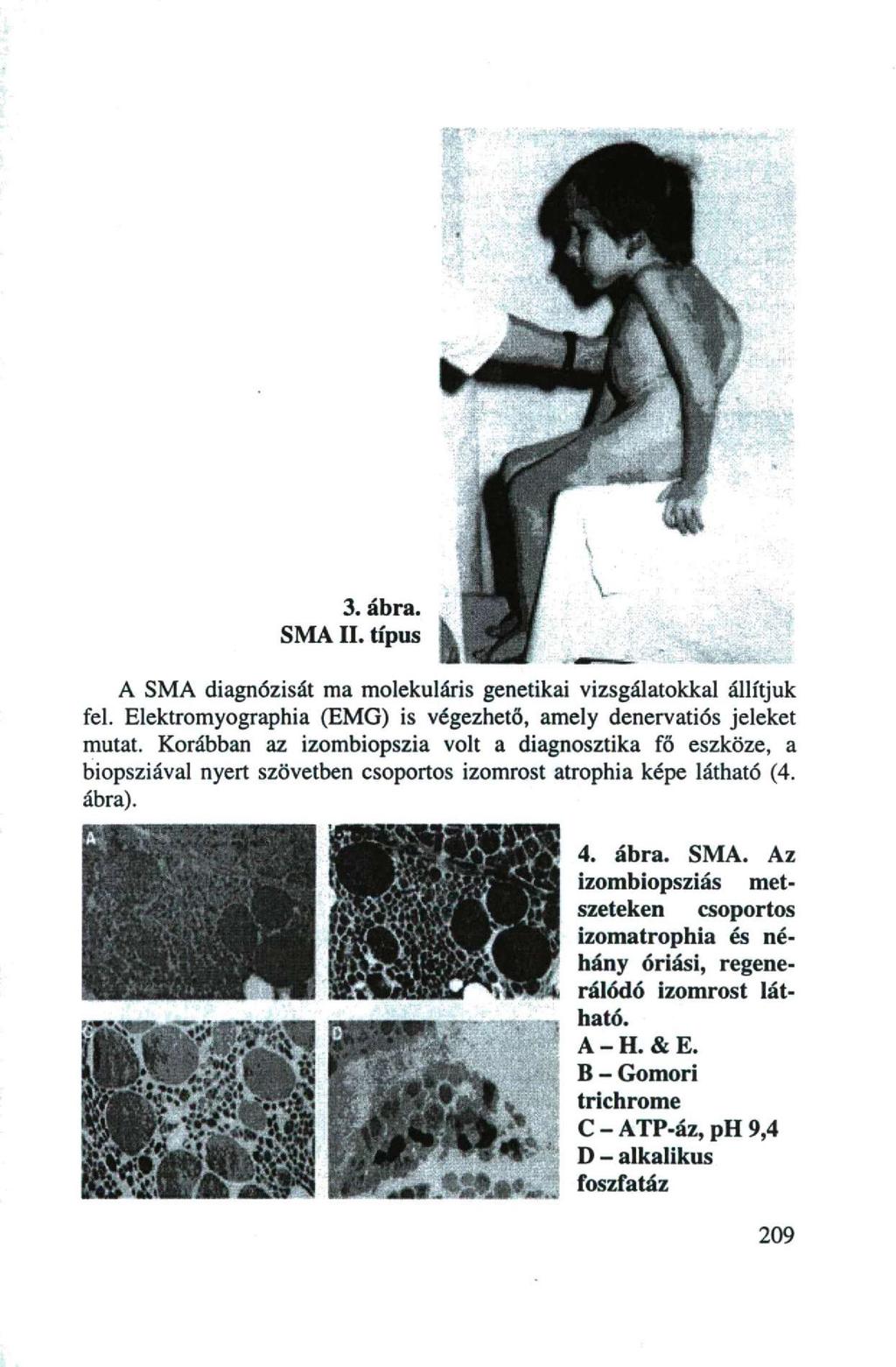 3. ábra. SMA II. típus A SMA diagnózisát ma molekuláris genetikai vizsgálatokkal állítjuk fel. Elektromyographia (EMG) is végezhető, amely denervatiós jeleket mutat.