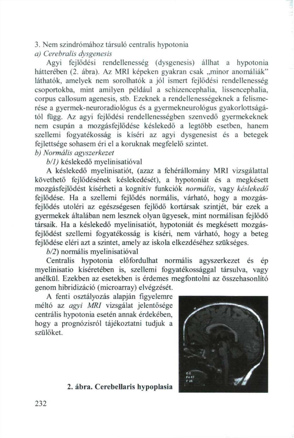 3. Nem szindrómához társuló centralis hypotonia a) Cerebral is dysgenesis Agyi fejlődési rendellenesség (dysgenesis) állhat a hypotonia hátterében (2. ábra).
