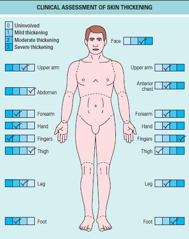 Betegségaktivitás, kimenetel SSc Bőr: modified Rodnan skin score (MRSS) magasabb mrss érték belszervi érintettség gyakoribb magasabb mortalitás korai dcssc mrss rapid progresszió az első 3 évben