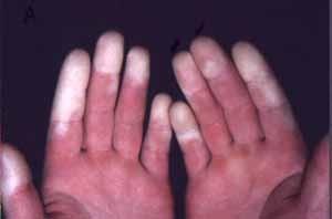 Klinikai kép korai jelek: Raynaud > fáradtság, arthralgia, myalgia, puffy fingers, bőr pigmentációjának változása,