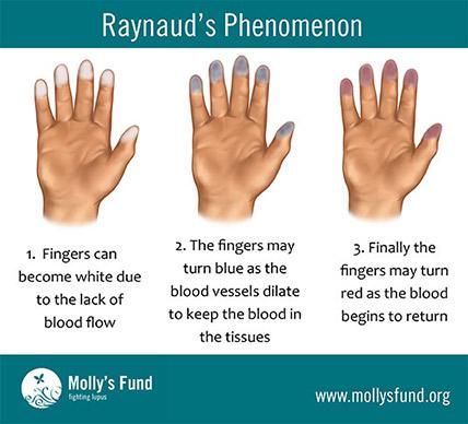 Klinikai kép Raynaud-jelenség 1, 2, illetve 3 fázisú lehet hideg hatására jelentkező ujjfájdalom Secunder Raynaud-szindróma SSc (95%)>MCTD>SLE>DM,PM,