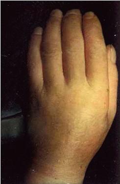 Klinikai kép, Bőrünetek kezdeti jelek: gyulladás, ödéma, puffy hand és