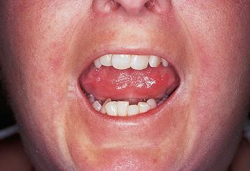 Klinikai kép, Bőrünetek csökkent szájnyitási