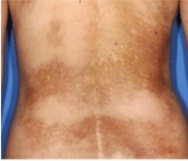 mandibula atrófia) a bőrtünetek az első 2 évben