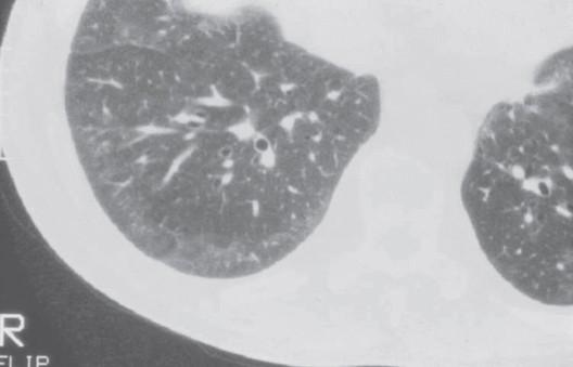 Klinikai kép, Tüdő Tüdő ILD (3) HRCT alveolitis, fibrózis jelei tejüveghomály, alveolaris septum megvastagodása subpleurális nodulusok, bronchiectasia, lépesméz PAH dyspnoe, fáradtság atípusos
