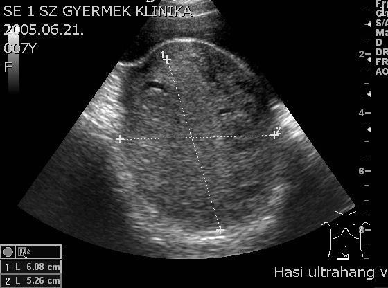 dermoid