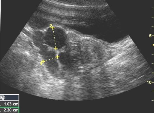 Genitalis tractust érintő kismedencei gyulladásos kórképek Gyermekkorban appendicitis, periappendicularis abscessus