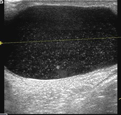 hydrocele