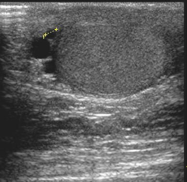 Cysták a scrotumban
