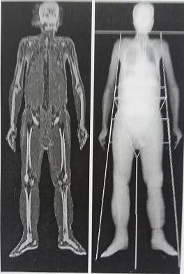 !!) BMI 27,4 (20-25) BMI 28,1 (20-25) BFMI 3,9 BFMI 8,6 FFMI 23,5 (> 17) FFMI 19,5 (> 17) Lean Mass g (L