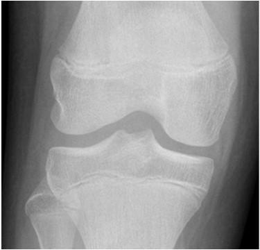 Hyalinporc, Porcos-fibrotikus (meniscus,