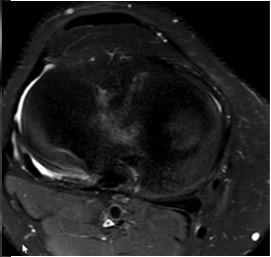 Osteochondrális törés