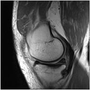 stimuláció, osteochondral autograft