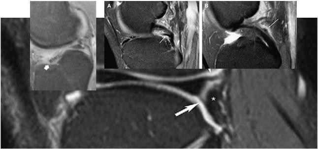 meniscal