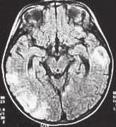 Neurofibromatosis Lisch-csomók az íriszen.