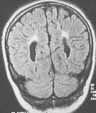 34 Idejében kiderül Az idegrendszeri kórképek csoportosítása Veleszületett Szerzett Fejlődési rendellenességek Genetikai betegségek Anyagcsere-betegségek Veleszületett neuromuscularis kórképek