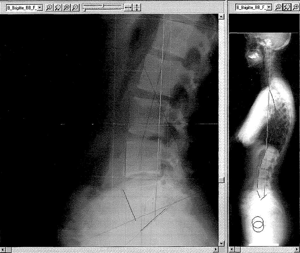 Az isthmicus spondylolisthesis biomechanikája A SpineView software Microsoft Windows környezetben fiit.