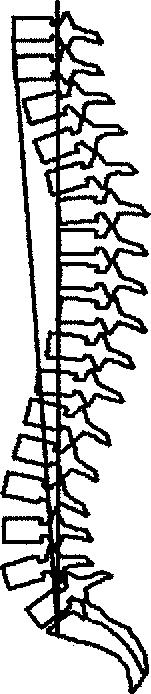 sacrofemoralis szög, és a sacrofemoralis távolság. Az SFAC algebrailag a sacrum dőlési szög és a sacrofemoralis szög összege (Duval-Beaupere, 1997).