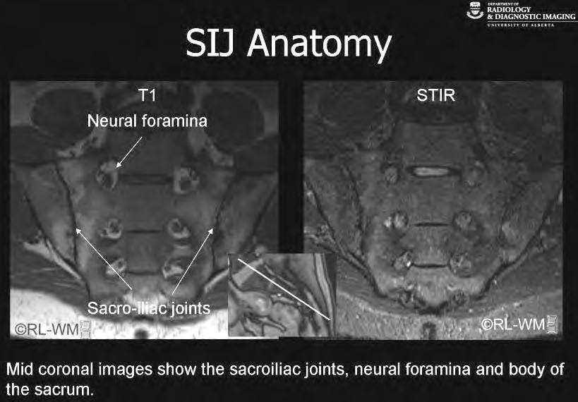 Az SI-ízületek MR vizsgálata: normál ízület anatómiája A sacroiliacalis ízületek anatómiája Ideggyök foramenek