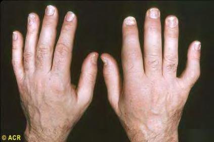 Polyarthritis (30-60%) A szimmetrikus forma a rheumatoid arthritises