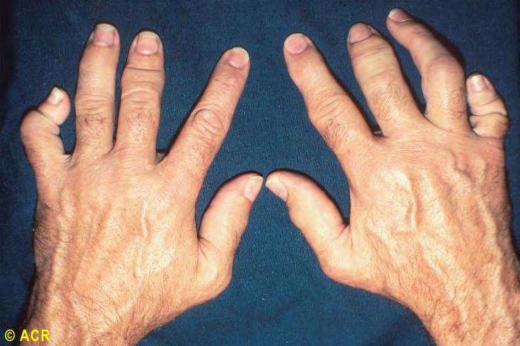 Arthritis mutilans (5%) Psoriatic arthritis: hands Súlyos