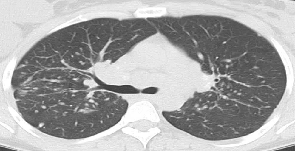 Sarcoidosis Mediastinum Ismeretlen etiológiájú