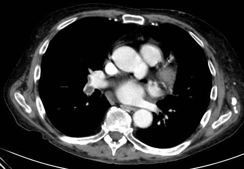 Tüdő embolia - angio CT dyspnoe,