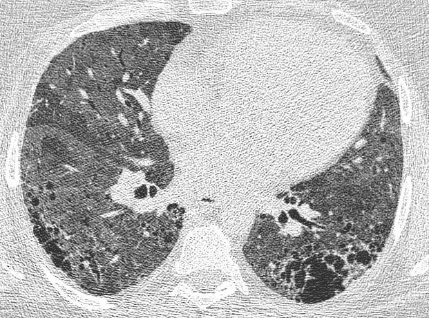 pneumonitis) Organikus anyagok inhalációja (Actinomycosis,