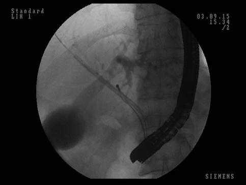 A beavatkozás után szövődményt nem észleltünk, a beteg panaszmentesen távozott otthonába. 4. ábra. Epeúti stent disztális vége köré kinyitott Dormia-kosár (1. eset)