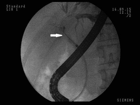 alapján ezúttal nem próbálkoztunk epeúti stent behelyezésével. A beavatkozást követően betegünk icterusa megszűnt, és a közlemény nyomdába való leadásáig eltelt egy hónap alatt nem újult ki.