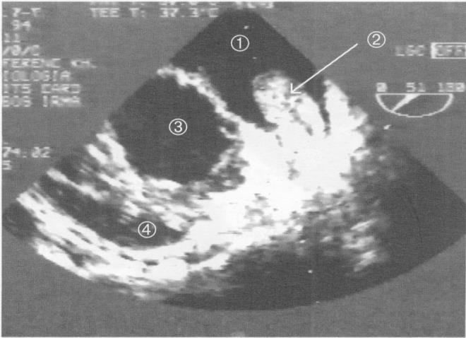 súlyos tünetek Gyakori palpitáció érzés, arrhytmia Cardiogén eredet