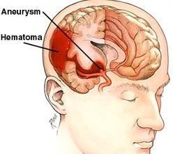 ruptúra - 75% (30-60 év) Arteriovenosus malformáció - 5%