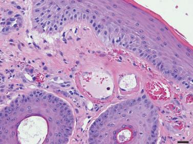 vasculitis (60%) Kevert sejtes (60%) Arteritis (15%) Prof.