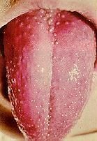 Skarlát angina A típusú streptococcus haemolyticus (erythrogen toxin) súlyos általános állapot, nyelési fájdalom, nyirokcsomó duzzanat, táplálkozási zavar 24 óra múlva felső