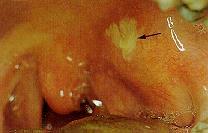 Peritonsillaris abscessus féloldali nyelési panasz fülbe sugárzó fájdalom szájzár, magas láz gombócos, galuskás