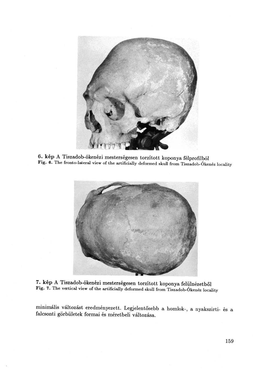6. kép A Tiszadob-ókenézi mesterségesen torzított koponya félprofilból Fig. в. The fronto-lateral view of the artificially deformed skull from Tiszadob-Ókenéz locality 7.