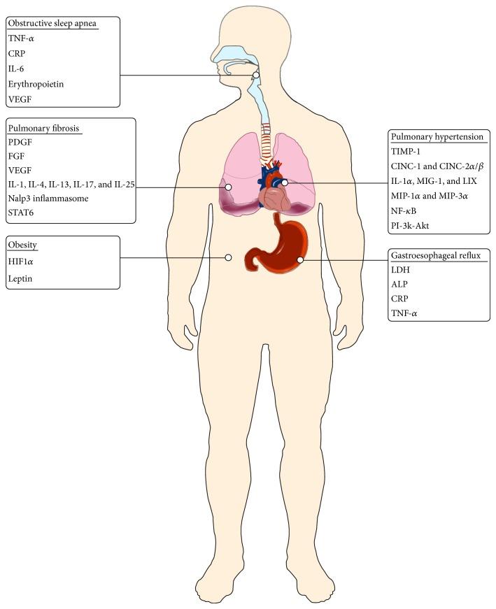 Szisztémás gyulladás, társbetegségek pulmonalis fibrosisban.