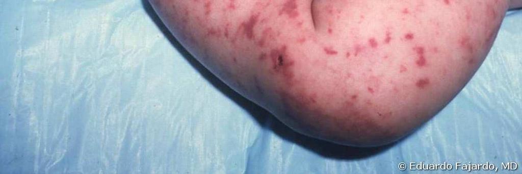 risk csoport: (SBI: 1%) - 28-90 napos - WBC: 5000-15 000/ul vagy éretlen alakok száma <1500/ul - MRTG: infiltráció - LP: WBC <10/ul - vizelet