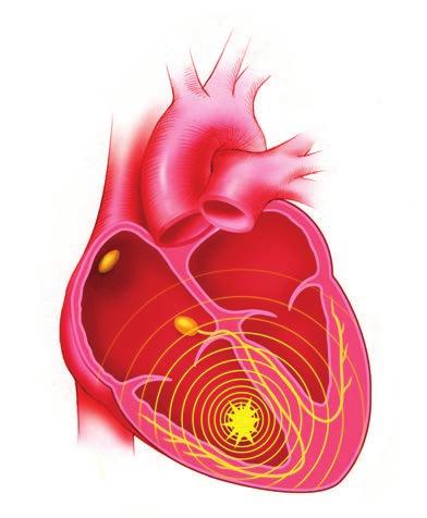 Rendellenes elektromos jelek a kamrából 3. ábra: Példa a kamrai tachycardiára vagy szédülést érezhet.