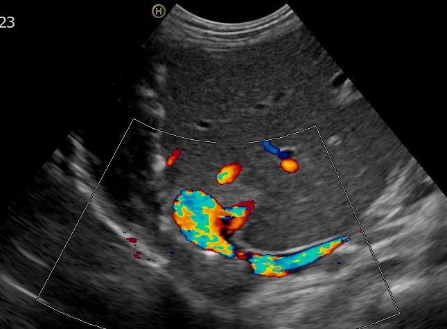 stenosis, vagy <2,5mm.